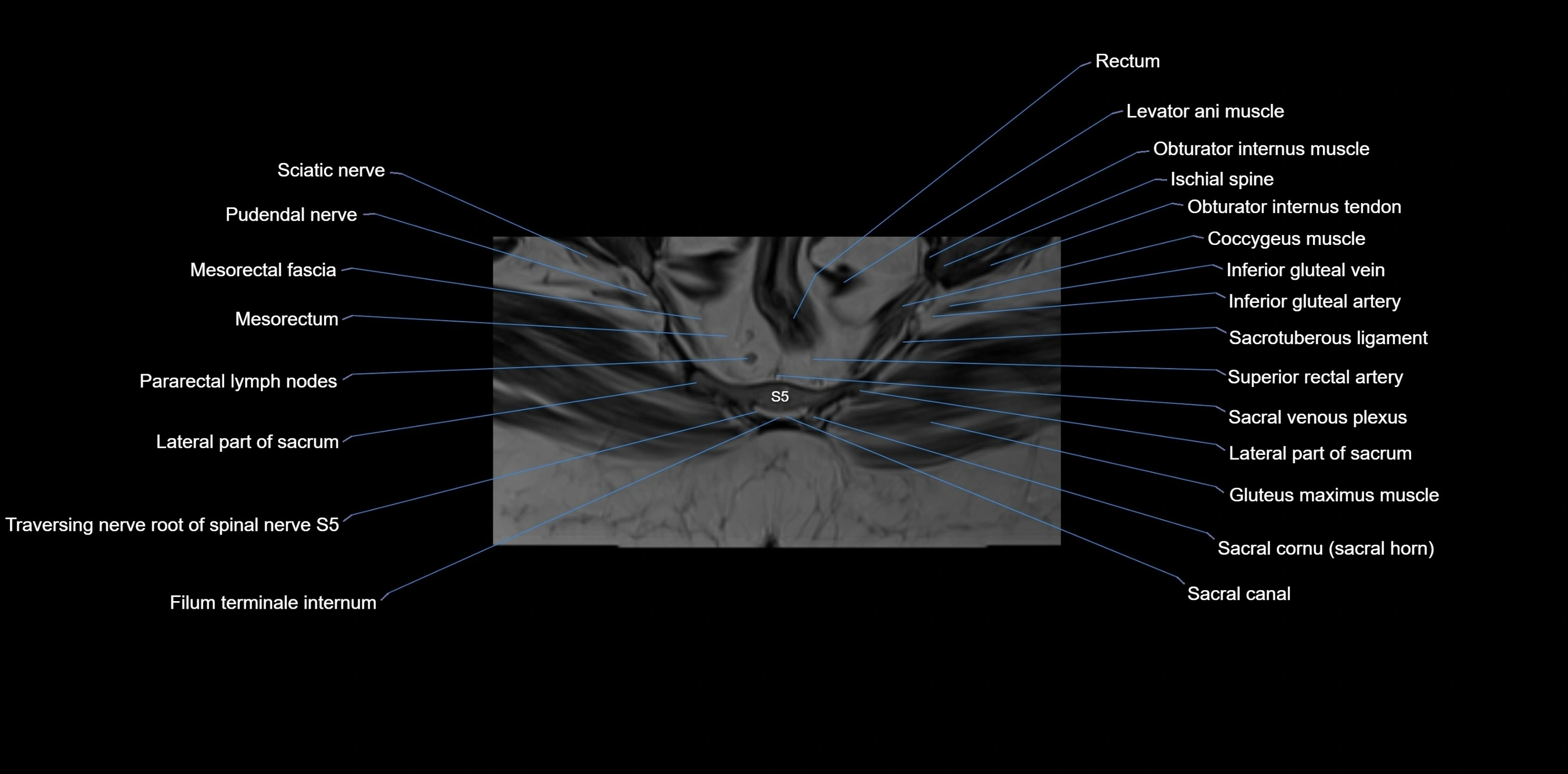 MRI sacrum, coccyx and sacroiliac joint axial cross sectional anatomy 3T  radiology  image-img-00001-00058.webp